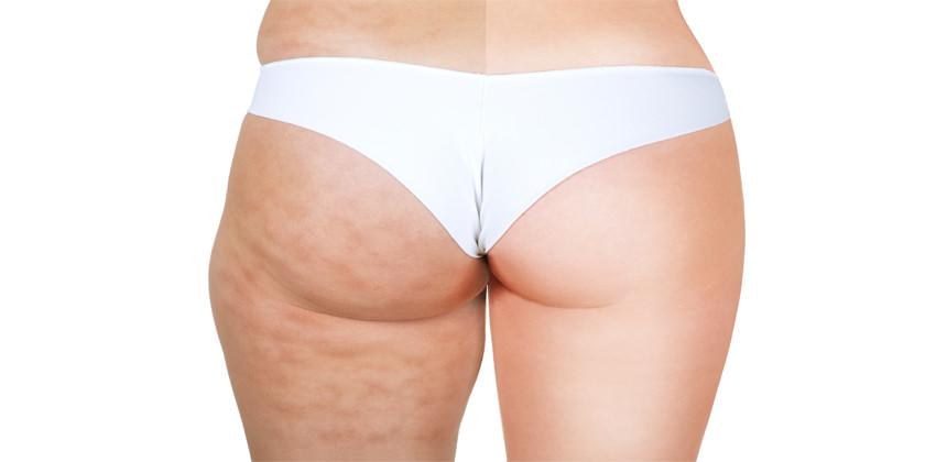 presoterapia cambios